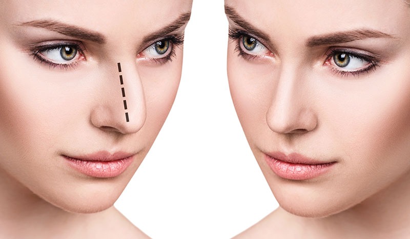 non-surgical rhinoplasty greenville