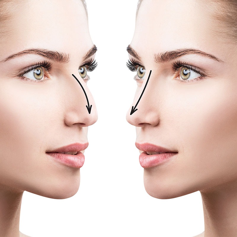 greenville affordable rhinoplasty surgery